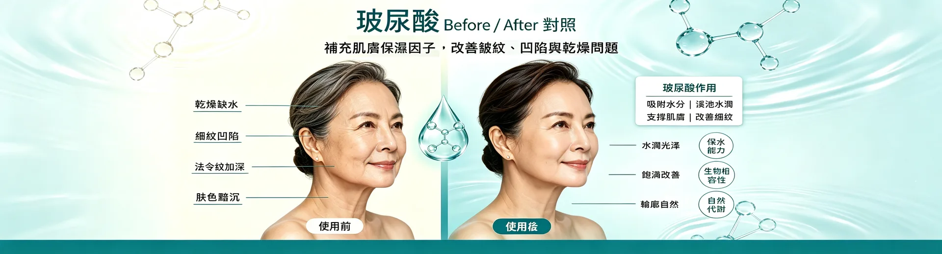玻尿酸